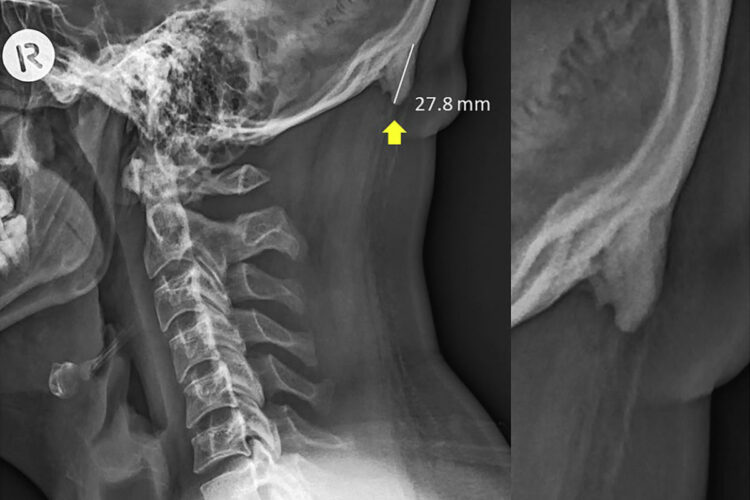 x-ray of a bone spur on the skull